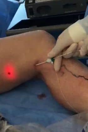Cirurgia de Safena a laser (Endolaser)