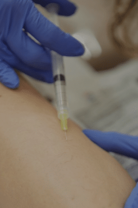 Escleroterapia líquida