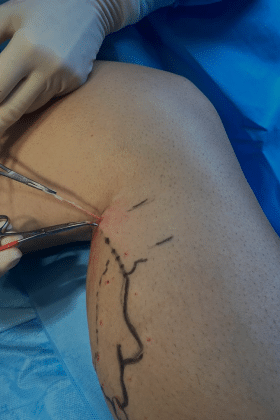 Microcirurgia de varizes