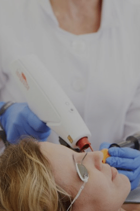 Laser para vasos no rosto